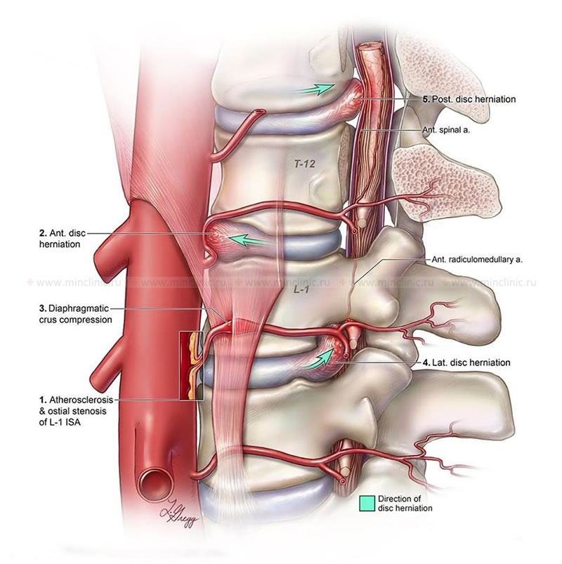 Causes of ischemia and stroke of the spinal cord: stenosis or compression of the segmental artery by herniated intervertebral disc, diaphragm pedicle syndrome.